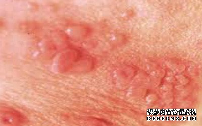 生殖器疱疹有多久的潜伏期